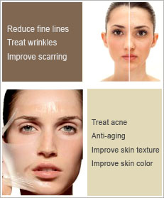 Glycolic Peel Ballymena Benefits