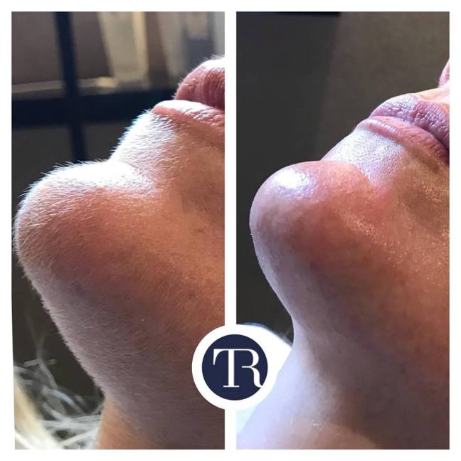 Dermaplaning Facial Ballymena